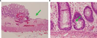 Case Report: “Primary Immunodeficiency”—Severe Autoimmune Enteropathy in a Pediatric Heart Transplant Recipient Treated With Abatacept and Alemtuzumab